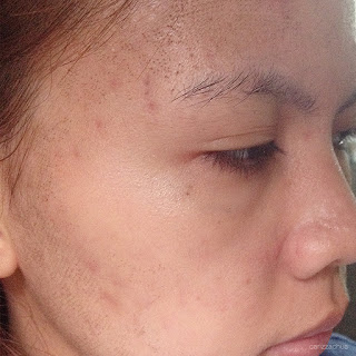 Fractional Co2 Laser Treatment Carizza Chua